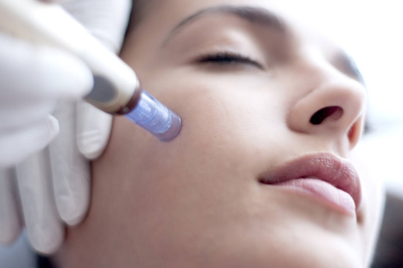 Microneedling