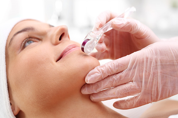 MICRONEEDLING