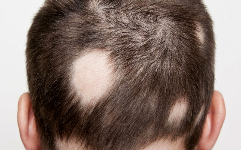 Baño Estados Unidos variable Alopecia areata - Dermatólogo Sevilla Dermavit Salud